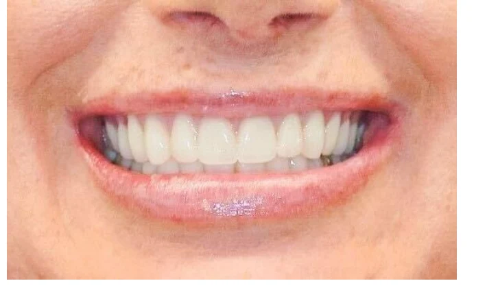 After Single implant restoration