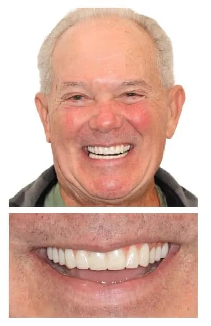 After Single implant restoration