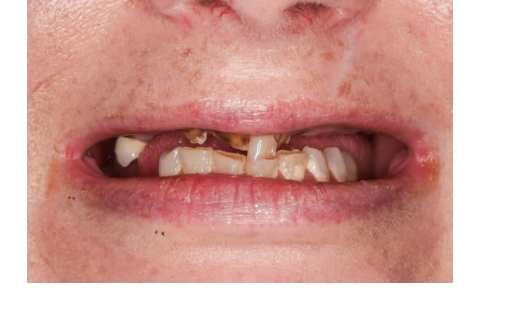 Before Single implant restoration