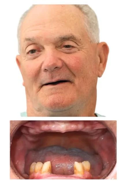 Before Single implant restoration